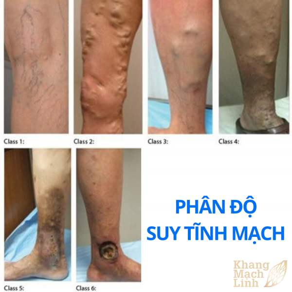 Bạn hỏi – bác sĩ trả lời những câu hỏi thường gặp về suy tĩnh mạch chi dưới