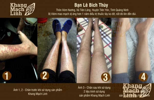 VIÊM MAO MẠCH DỊ ỨNG – KHÔNG CÒN LÀ NỖI LO